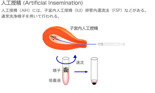 卵管の通過性を評価する検査