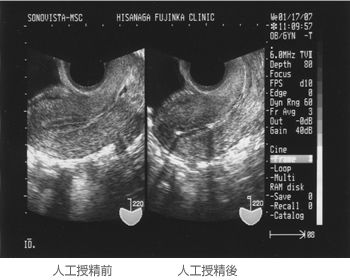 人口授精