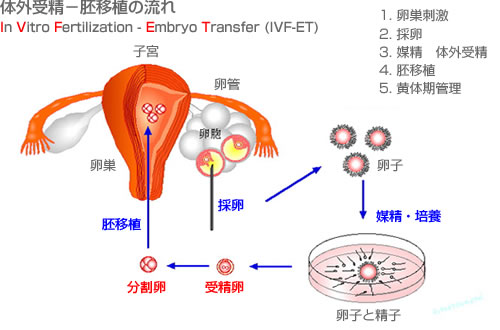 体外受精－胚移植の流れ