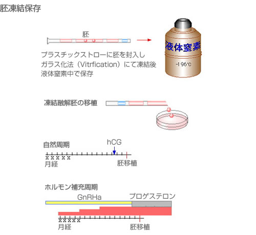 胚凍結保存