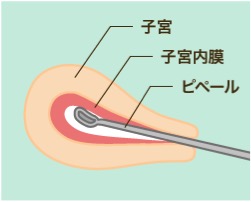 ERA検査1